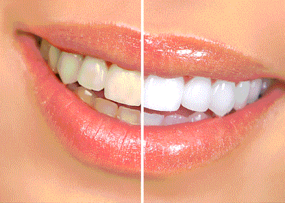 PASTA DENTAL BLANQUEADORA OBSESSIVE™